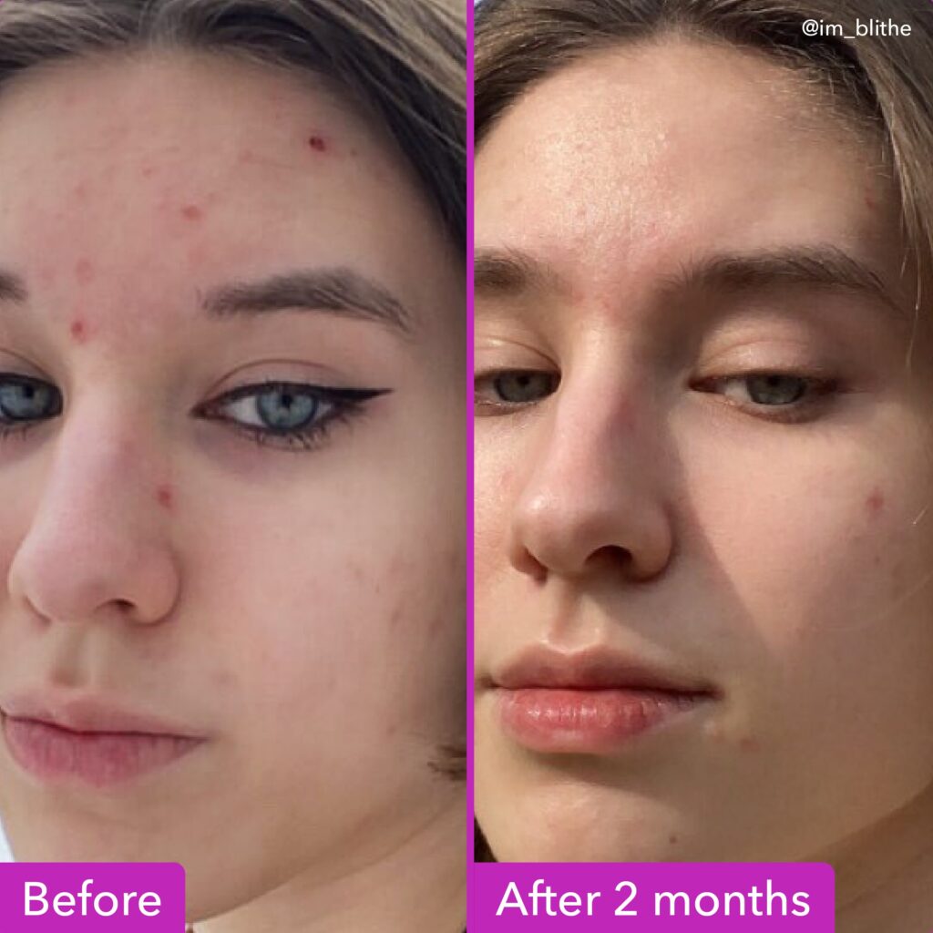 Good-Molecules-Discoloration-Correcting-Serum-1024x1024 Dark Spots Ruining Your Holiday Glow? Good Molecules Discoloration Correcting Serum Just Faded My Hyperpigmentation in Weeks – The Viral Skin Fix You Need Now!